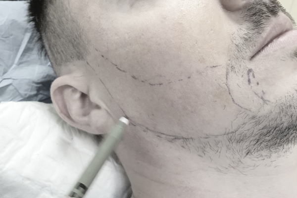 greffe de barbe